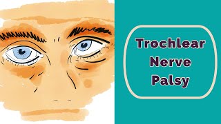 Trochlear Nerve Palsy Rapid Review [upl. by Corilla]