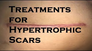 Treatments for Hypertrophic Scars [upl. by Pas392]