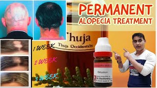 5 Best Homeopathic Medicine For Alopecia Areata Permanent Treatment  Regrow New Hair [upl. by Scotney]