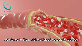 External Counterpulsation EECP  ECP Testimonial Heart Fit Clinic [upl. by Gala]