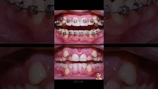 Braces process [upl. by Kinnon]