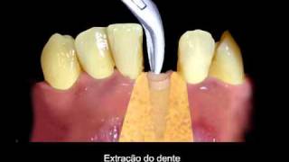 Extração dentária com retalho [upl. by Anirol]