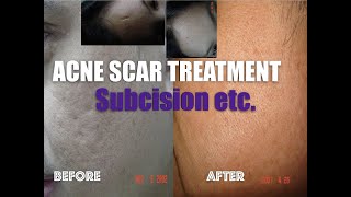 Acne scar treatment before and after  A compilation of scar treatments done by Dr Julieta Arambulo [upl. by Aizatsana251]