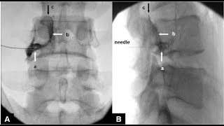 Fluoroscopic guided Lumbar epidural injection  Right L4 nerve root [upl. by Domela]