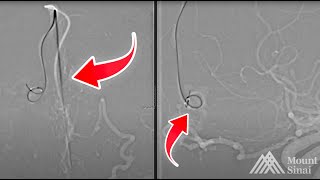 Anterior Ethmoidal Fistula Transvenous Balloon Assisted Approach [upl. by Htiderem89]