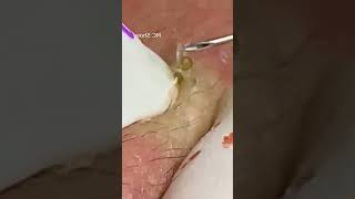 Pickel Ausdrücken Blackheads Mitesser Entfernung 🔴 62 [upl. by Adnolohs]