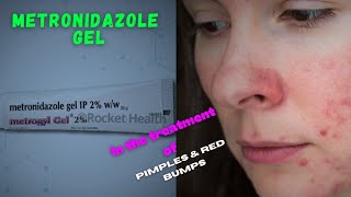 Metronidazole gel for Pimples and Red bumpsTreating Rosacea and Inflammatory Lesions [upl. by Irpak519]