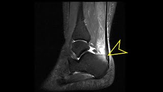 Ankle MRI Haglunds Syndrome [upl. by Birdella]