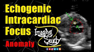 Fetal Echogenic Intracardiac Focus  Ultrasound  Anomaly  Case 261 [upl. by Endres]