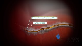 Meralgia Paresthetica  Symptoms and Treatments at Southern Nevada Pain Center [upl. by Llenrac898]