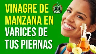 ✅Empieza A Utilizar El VINAGRE DE MANZANA Y Mira Lo Que Le Ocurre Las Varices En Tus Piernas [upl. by Ahseki]