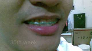 Braces Aug2009Aug2010 [upl. by Desmund852]