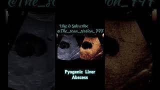 Pyogenic Liver Abscess doctor baby abdomen usg pregnant pregnancyjourney education [upl. by Nosnek897]