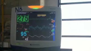 心電図モニター 実際の測定 Ventricular Tachycardia VT心室頻拍 NIHONKOHDEN Vismo [upl. by Perkin]