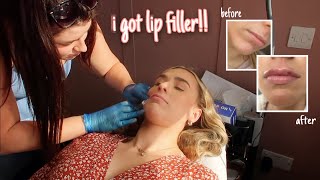 I GOT LIP FILLER FOR THE FIRST TIME 05 ml natural lips healing process start to finish [upl. by Willis]