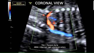 Secondtrimester fetal aberrant right subclavian artery [upl. by Nap]