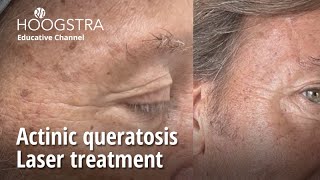 Actinic queratosis  Laser treatment  23276 [upl. by Irolav]