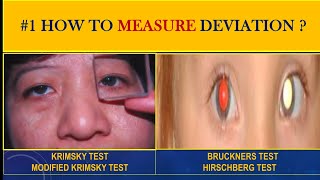 Measuring squint  Krimsky and Modified KrimskyTest  Bruckners test [upl. by Hardigg448]