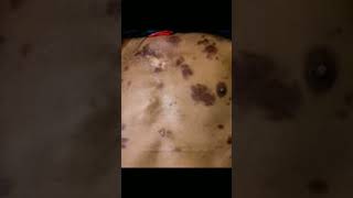 kaposi sarcoma clinical presentation [upl. by Annawik521]