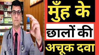 MOUTH ULCERS APHTHAE  मुँह के छालों की अचूक दवा  HOMEOPATHIC TREATMENT [upl. by Analad755]