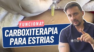 CARBOXITERAPIA FUNCIONA NO TRATAMENTO DE ESTRIAS  DR JOÃO TASSINARY [upl. by Armington276]