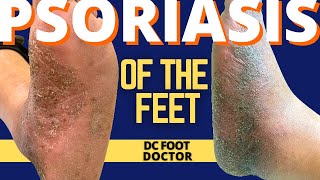 Psoriasis and the Feet Part 2 Treating Pustular Psoriasis of the Skin [upl. by Alilahk59]