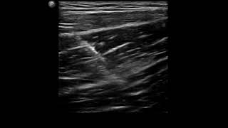 Groin Ultrasound Adductor Tendon Sheath Injection [upl. by Anidan]