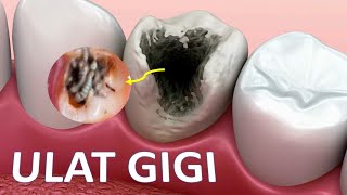 Telah ditemukan PENYEBAB SAKIT GIGI BERLUBANG selama ini ‼️ ULAT GIGI [upl. by Nylorac]