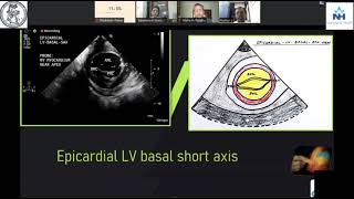 Dr Kumar C Epicardial echocardiography [upl. by Anihta398]