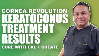 Keratoconus Treatment Results with CREATE Protocol and Crosslinking with Dr Motwani [upl. by Ranee]