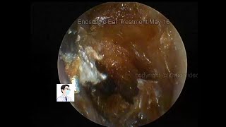 Reexamination of cholesteatoma of the external auditory canal 20220516 [upl. by Ettesoj]