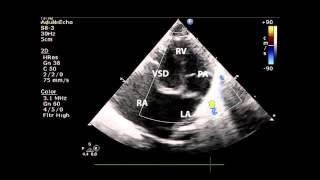 VSD echo [upl. by Hsotnas]