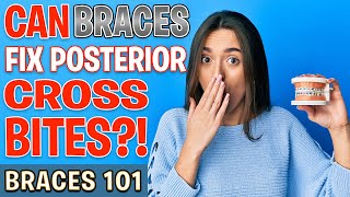 BRACES 101 Can Braces Fix POSTERIOR CROSSBITES  Treatment Minute Talk [upl. by Bergquist]