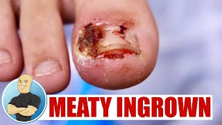 JUICY INFECTED INGROWN TOENAIL REMOVAL [upl. by Robin302]