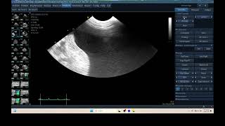 IQ 309 ASCITES BLOOD LYMPHOMA ULTRASOUND [upl. by Braeunig]