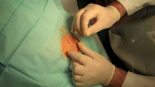 Pellet Implant Procedure [upl. by Acsot]