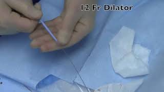 12 Fr Dilator without Incision [upl. by Ycniuqal]