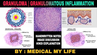 GRANULOMA  GRANULOMATOUS INFLAMMATION  Types Of Chronic Inflammation [upl. by Nednal]