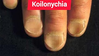 Leukonychia Platynychia and Koilonychia in Chronic iron deficiency anemia [upl. by Noella]