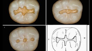 Class I  cavity prepration with Buccal pit amp Buccal extension  Mandibular 1st molar [upl. by Yrrag]