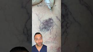 Removing Spider Veins With Sclerotherapy Treatments  Dr Somji Explains [upl. by Endo629]