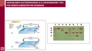 Hematology  2  U1L30  Confirmatory test for sickle cell anaemia [upl. by Oiraved]