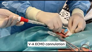 ECMO cannulation [upl. by Tanaka506]