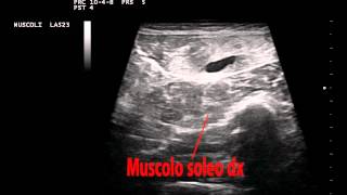 Muscolo gastrocnemio destro lesione gemello laterale [upl. by Ehlke]