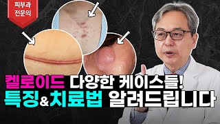 켈로이드의 다양한 케이스들 각각에 맞는 특징과 치료법 알려드리겠습니다 켈로이드 [upl. by Sidwel]