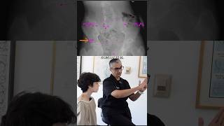 9 Years Limping and SEVERE Back Pain  Coccyx amp Pelvis Adjustment shorts [upl. by Ahsenhoj324]