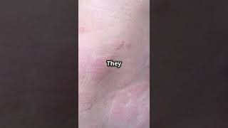 What is Urticaria disease most common nowadays urticaria trending viralvideo viral shorts you [upl. by Sommer]