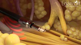 LazerLift  The Minimally Invasive Laser Facelift [upl. by Eibob92]