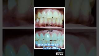 Teeth whitening in the Dental office by Dr Aftab jahan smile designing dentist teeth whitening [upl. by Bak99]