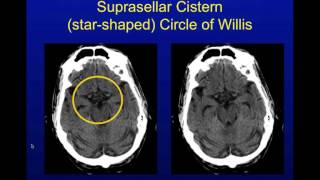 Head CT Interpretation Made Easy [upl. by Michi]